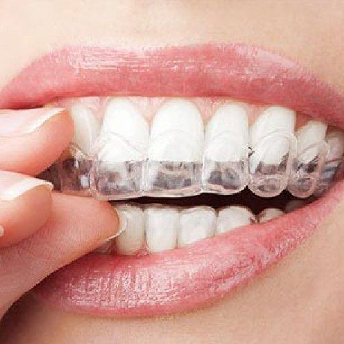 The Art And Science Of Dental Braces